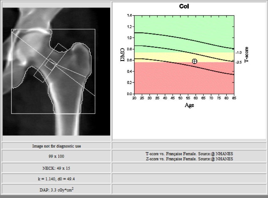  Ostéodensitométrie images d'examen