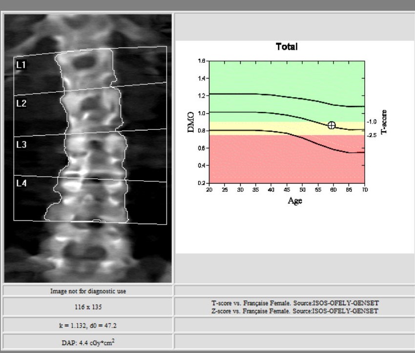  Ostéodensitométrie images d'examen