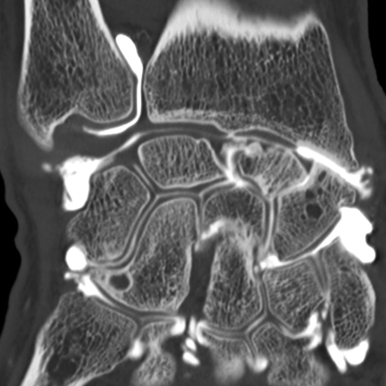 Arthroscanner images d'examen