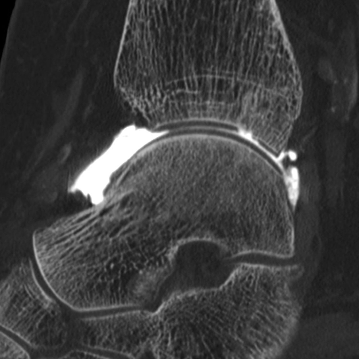 Arthroscanner images d'examen