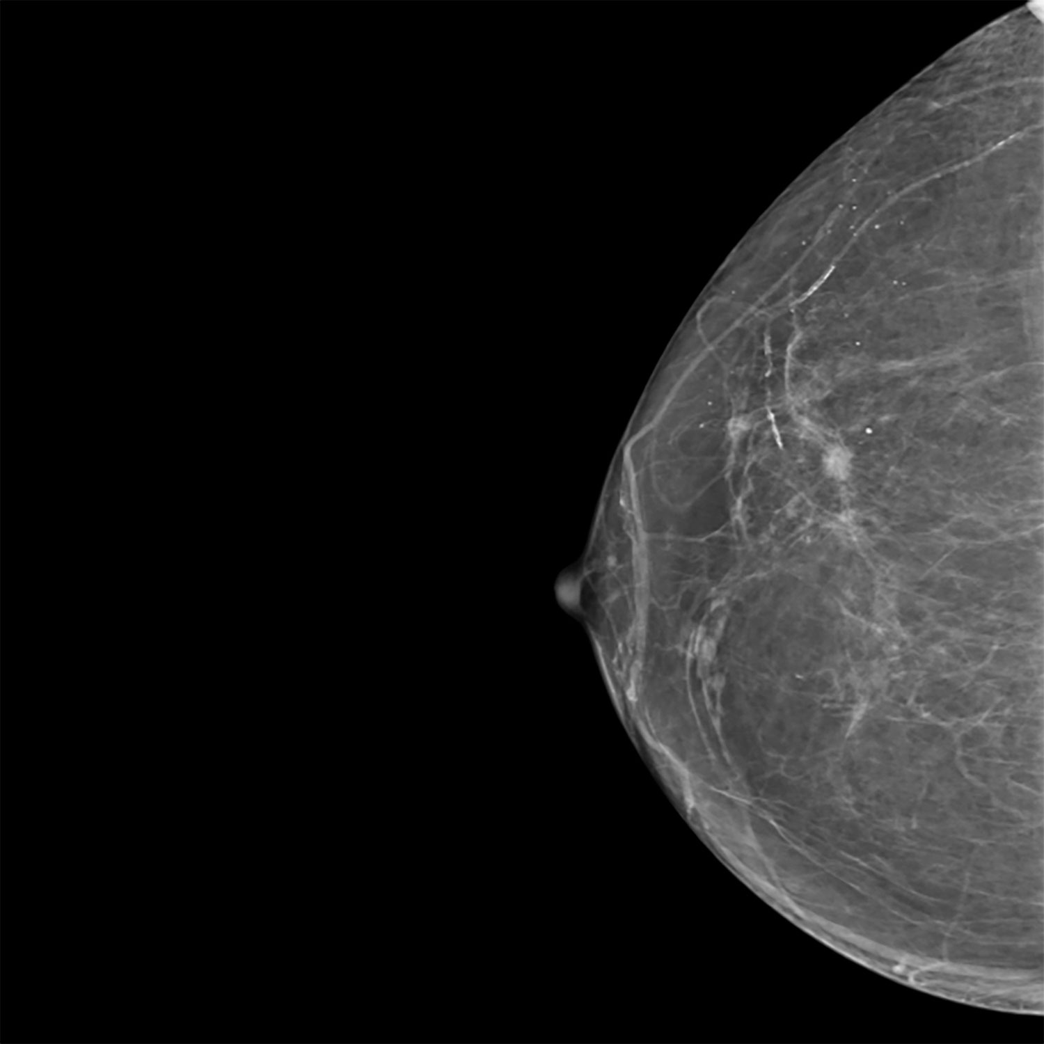  Mammographie et biopsie mammaire images d'examen