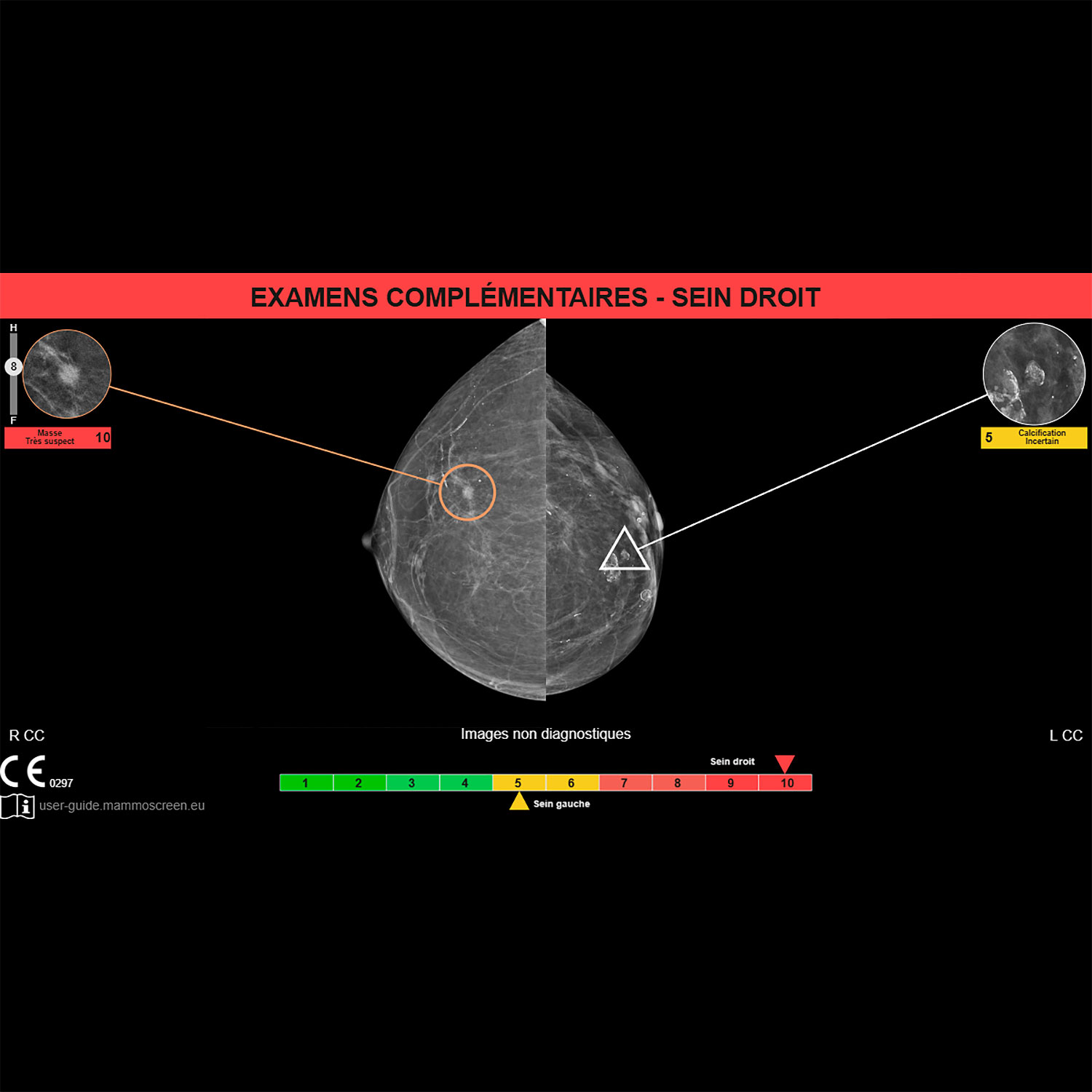 Mammographie et biopsie mammaire images d'examen